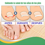 PARCHE CORRECTOR UÑA NANEL – Corrige, protege y recupera la forma natural de tus uñas